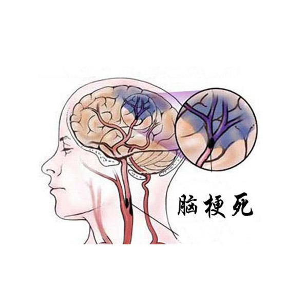 急性脑梗死静脉溶栓宣传